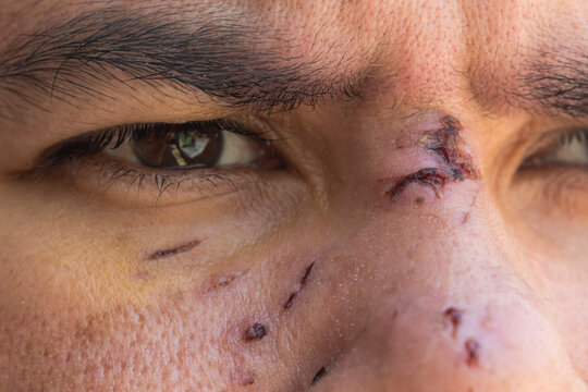 The Reality of Facial Injuries